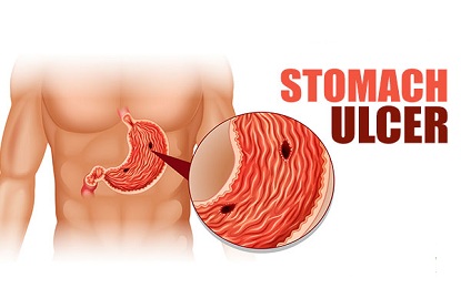 Suffering From Stomach Ulcer Infection- Avoid These 7 Things