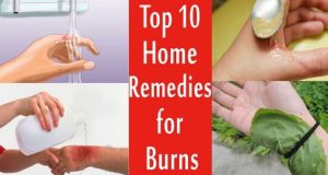 Did You Know These 10 Natural Home Remedies for the Treatment of Burns