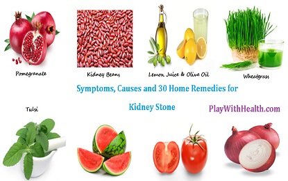 Symptoms, Causes and 30 Home Remedies for Kidney Stone