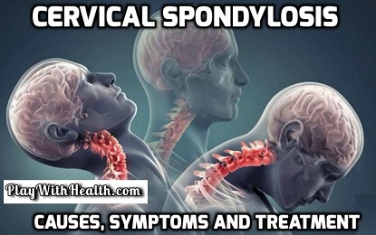 Cervical Spondylosis – Causes, Symptoms and Treatment - NATURAL HEALTH