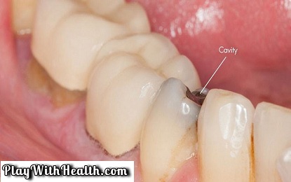 4 Effective Home Remedies For Cavities