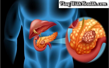 Top 8 Symptoms To Identify Pancreatic Cancer