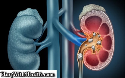 11 Ways To Get Relief From Kidney Stone