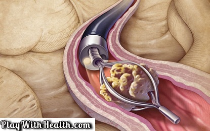 15 Effective Ways To Remove Kidney Stones Without Surgery